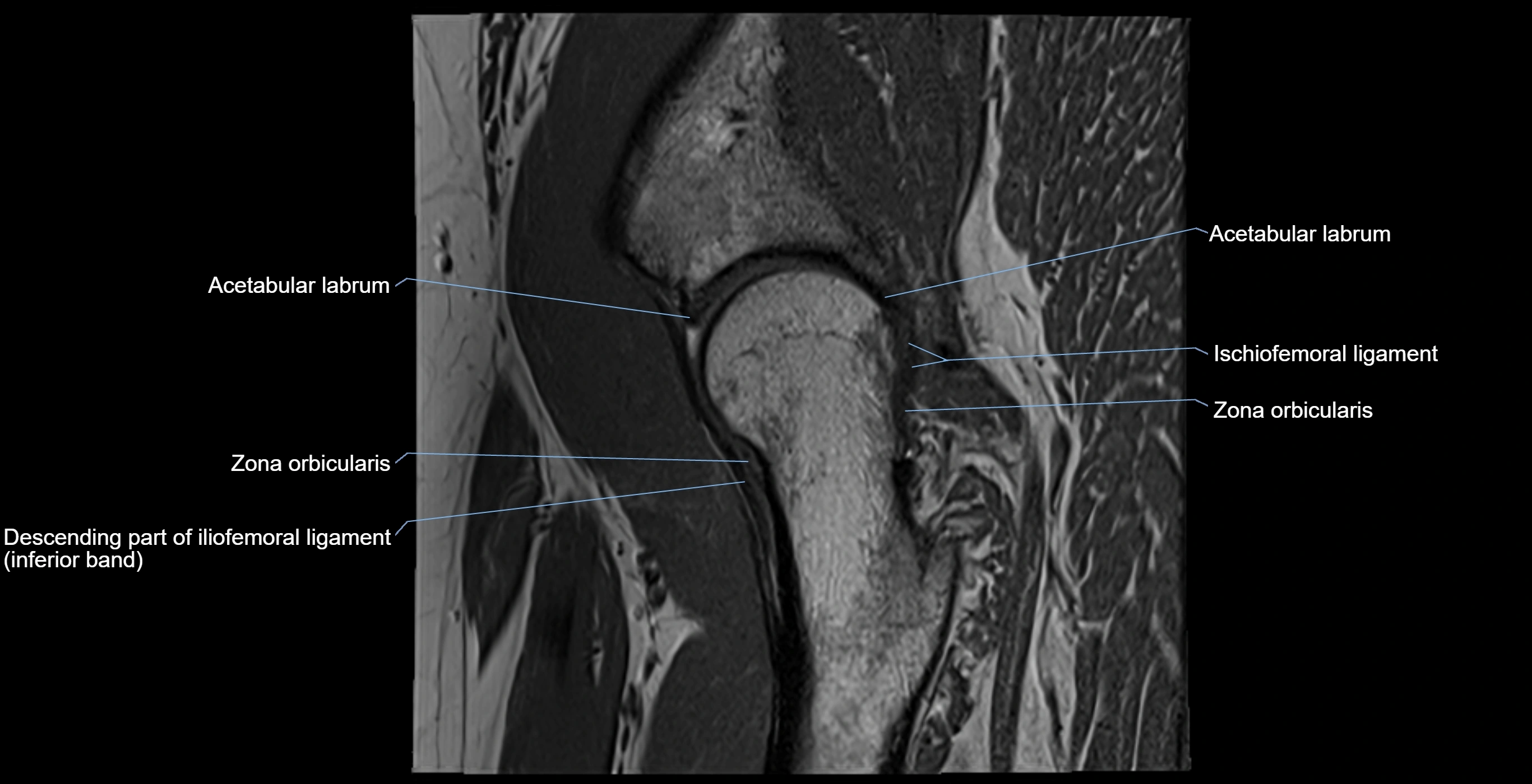 MRI Hip ligaments sagittal cross sectional anatomy 3T  radiology  image-img-00001-00013.webp